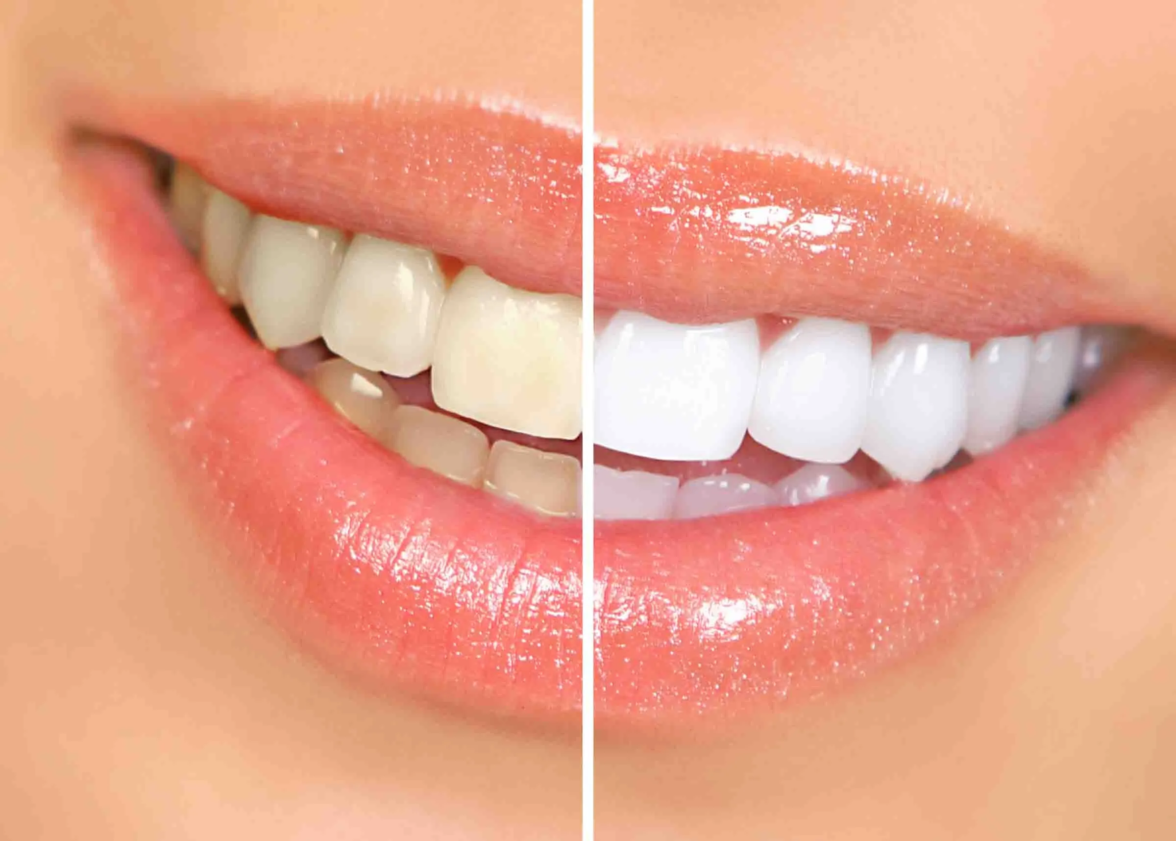 teeth-whitening-1_1735_022123.jpg